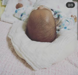 退院直後の息子の頭。枕を使っているので仰向けができています。